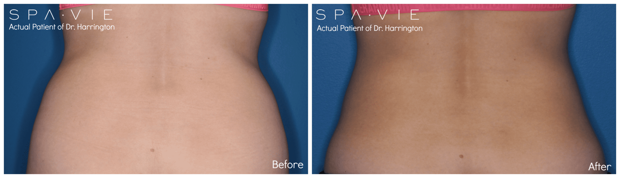 CoolSculpting® img 2