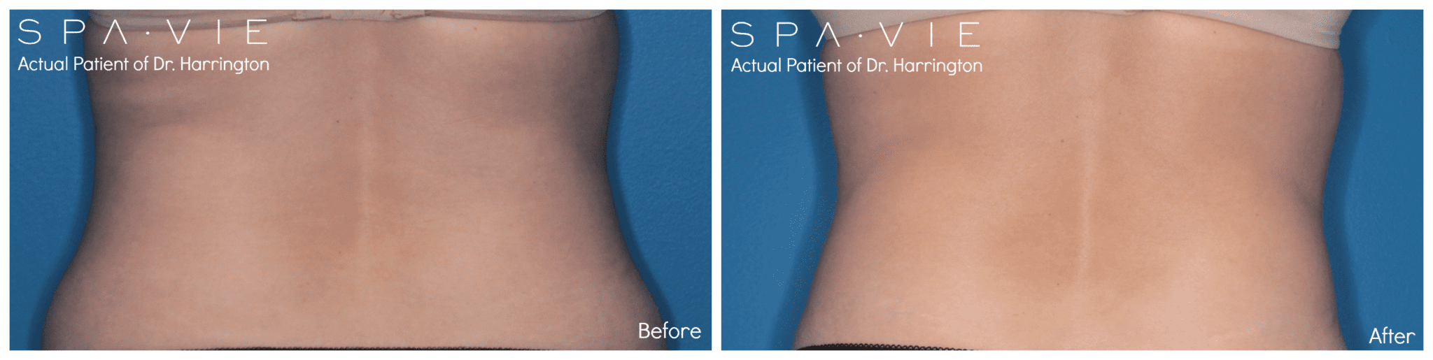 CoolSculpting® img 3