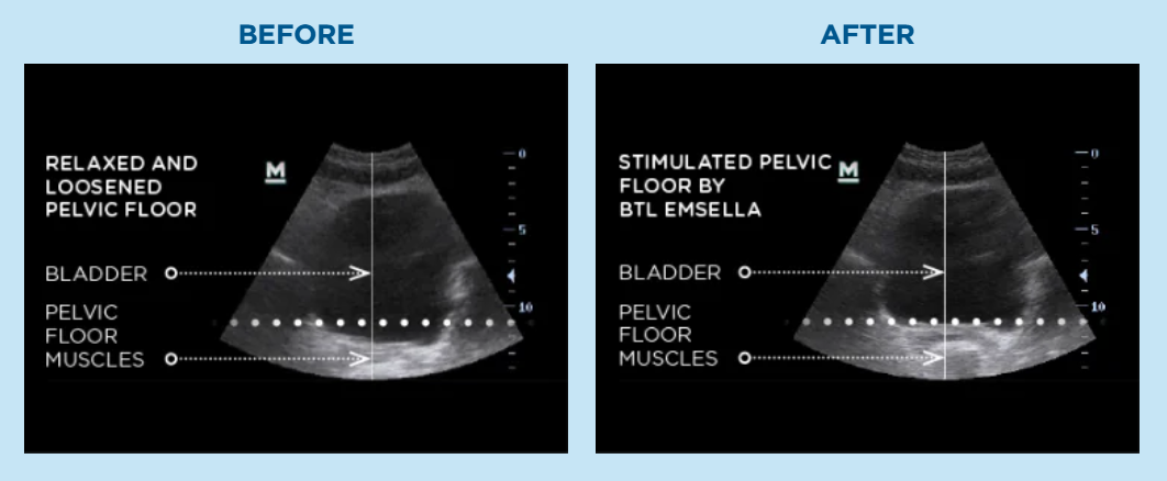Emsella Before After