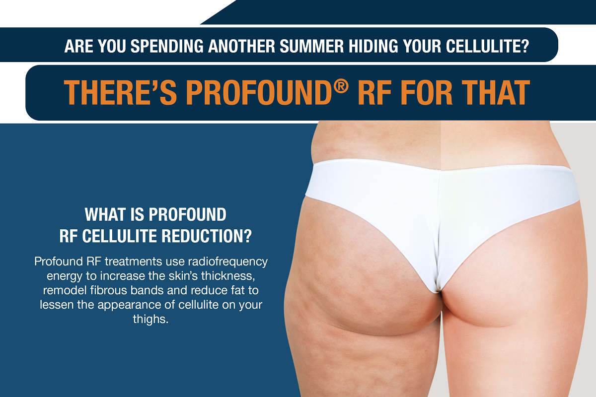 Are You Spending Another Summer Hiding Your Cellulite? [Infographic]